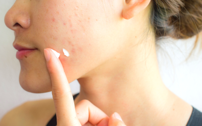 Acne vulgaris: Die häufigsten Probleme jugendlicher Haut und deren Behandlungsmöglichkeiten